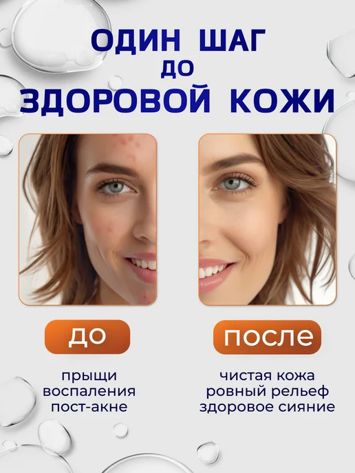 SkinSmart Тоник для лица, средство от прыщей и акне, 50 мл, фото 4
