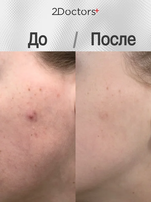 2Doctors Гель для умывания от прыщей, вариант, фото 4