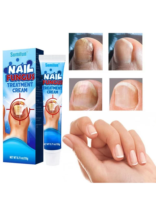 NAIL FUNGUS Treatment cream Wildberries 232179529